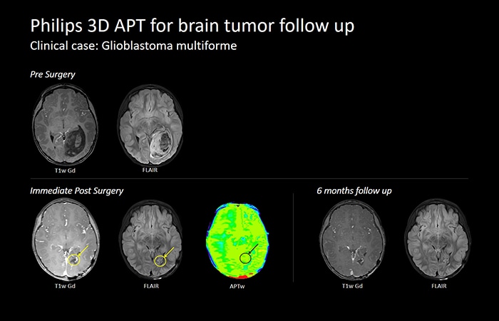 Brain Tumor download image