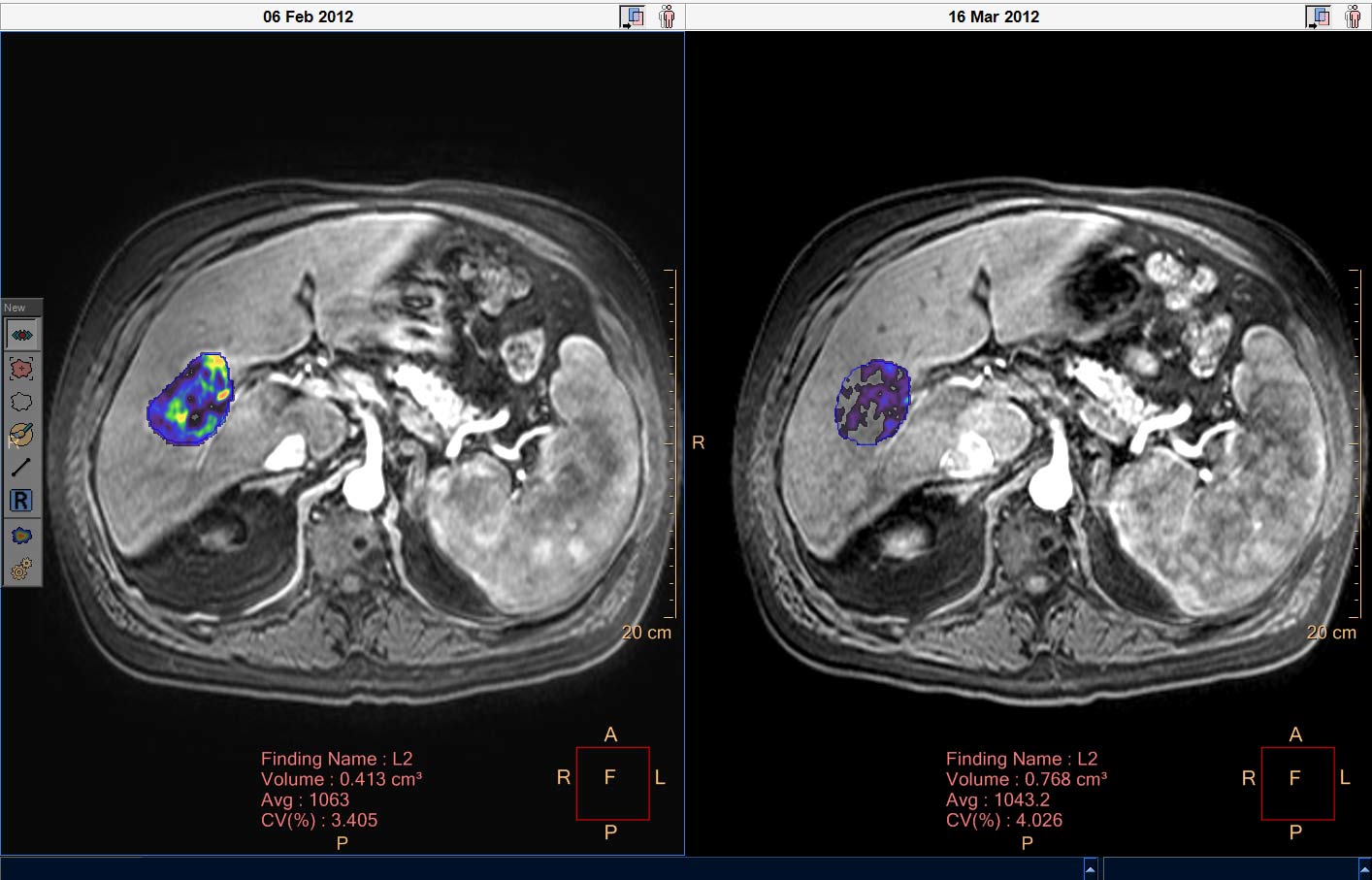 Liver lesion follow-up download image
