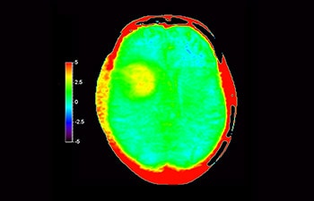 Glioblastoma image