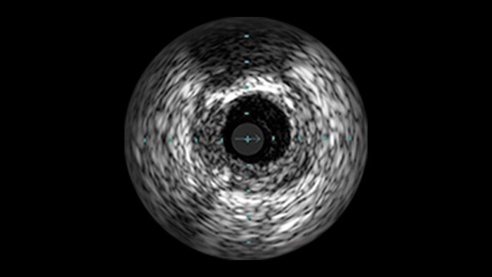 Calcified Lesions