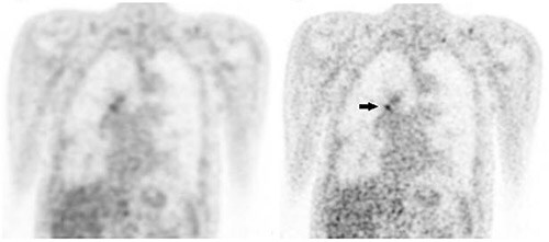 lung cancer image zwolle