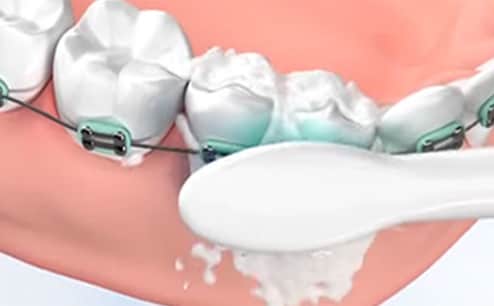 Комплект Philips Sonicare Ortho – Philips Oral Healthcare